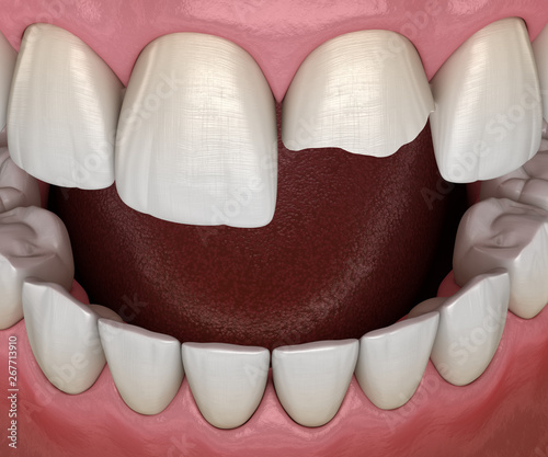 Broken central incisor tooth. Medically accurate 3D illustration of human teeth and dentures concept