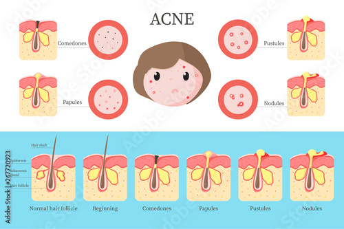Acne types and formation infographics, vector flat illustration