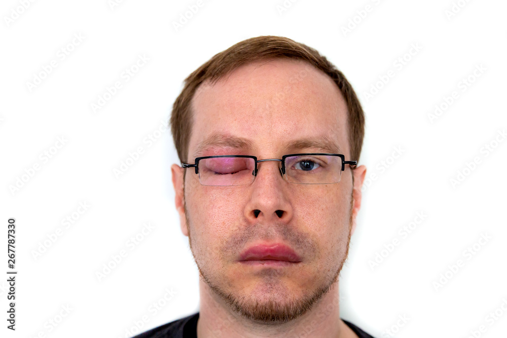 Obraz premium ein Mann mit geschwollenem Auge und dicker Lippe von einem Bienenstich