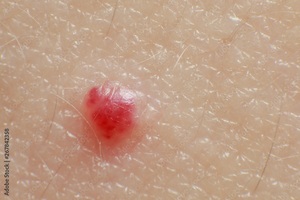 Cherry Angiomas on male skin super macro close up Stock Photo Adobe