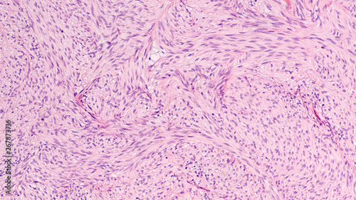 Картината върху платно Microscopic image of a gastrointestinal stromal tumor (GIST)