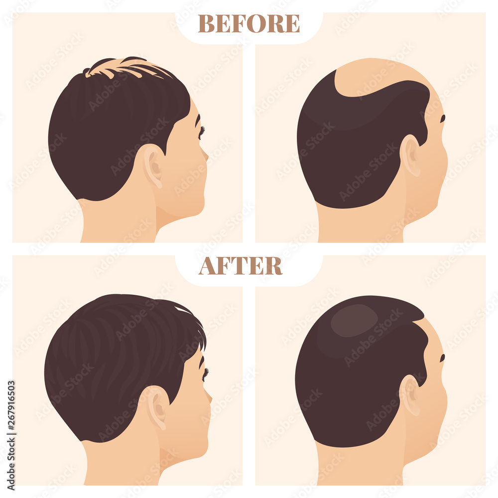 Male and female pattern hair loss set. Baldness treatment result in men and  women in side view. Before and after concept. Alopecia infographics medical  vector template for clinics. Stock Vector | Adobe