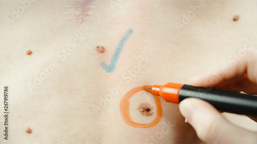 Melanoma skin mole and healthy mole