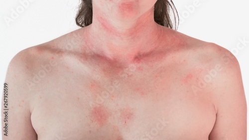 Allergic skin reaction on the female neck and face - red rash