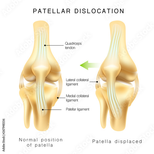 Normal position of kneecap and patella displaced