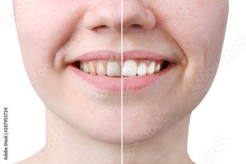 whitening or bleaching treatment ,before and after ,woman teeth and smile, close up, isolated on white