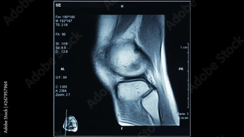 Time Lapse video animation of R.M.N. Nuclear magnetic resonance, of human knees, with cross-section and sagittal section. photo