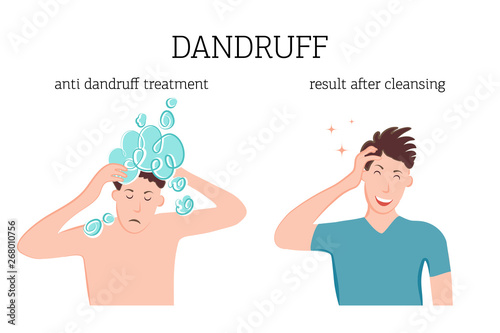 Treatment of dandruff and seborrhea, the concept of before and after