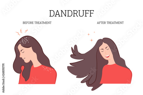 Treatment of dandruff and seborrhea, the concept of before and after