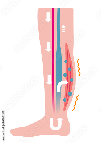 Cause of swelling(edema) of the legs. Water leaks from the veins and swelling occurs. flat illustration ( no text ).