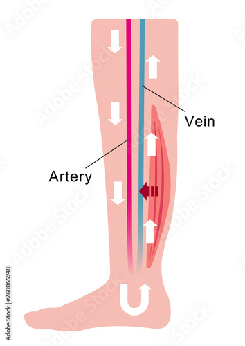 Cause of swelling(edema) of the legs. flat illustration of normal leg