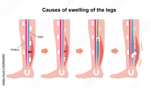 Cause of swelling(edema) of the legs. flat illustration. photo