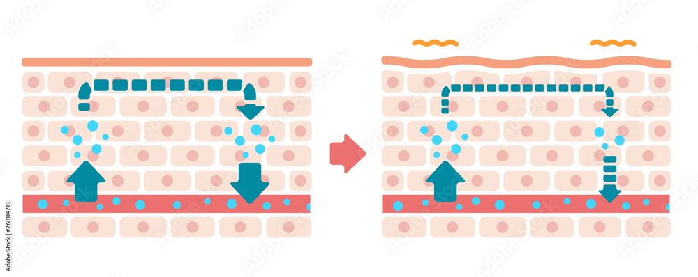 Comparison illustration of normal skin and swollen skin (no text) Comparison illustration of normal skin and swollen skin (no text)