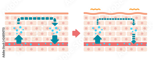 Comparison illustration of normal skin and swollen skin (no text)