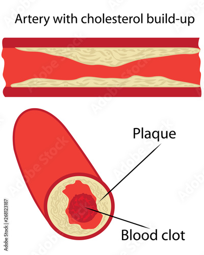 cholesterol plaque in artery