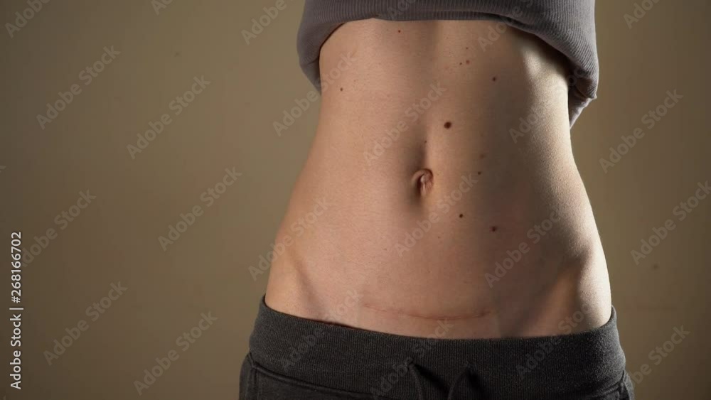 C section Cesarean operation heal after mother holding baby postpartum recovery