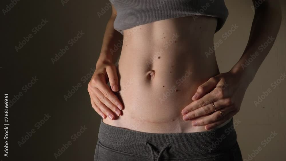 C section Cesarean operation heal after mother holding baby postpartum recovery C section Cesarean operation heal after mother holding baby postpartum recovery