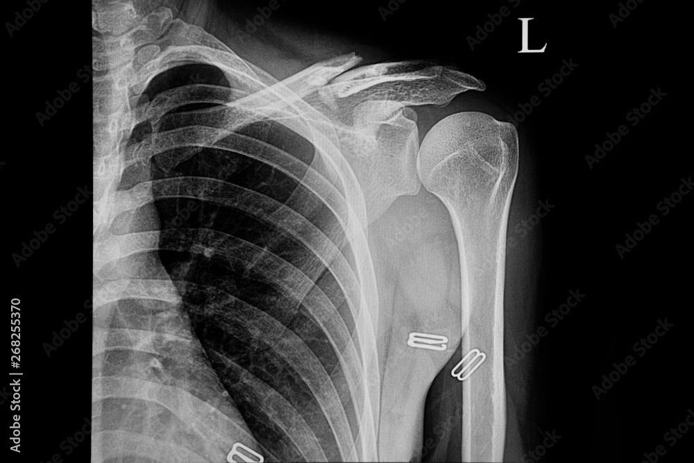 Xray film of a patient with fractured left clavicle. Xray film of a patient with fractured left clavicle.