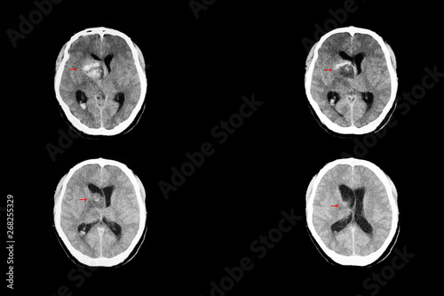 Valokuva Ct brain of metastatic cancer