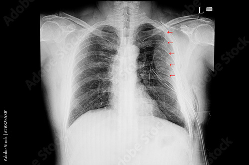 chest xray  film of a patient with multiple rib fractures