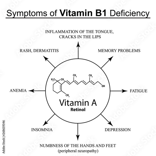Symptoms of vitamin B1 deficiency. Infographics. Vector illustration on an isolated background.