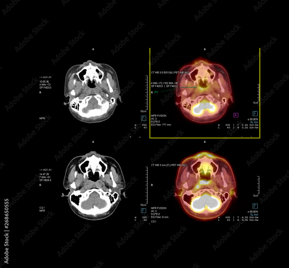 PET CT Scan image of the brain in axial plane comparison CT scan and ...
