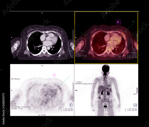 PET CT Scan image of whole body comparison Axial plane in CT scan and PET CT on the screen  for detect cancer recurrence in patient lung cancer disease . photo