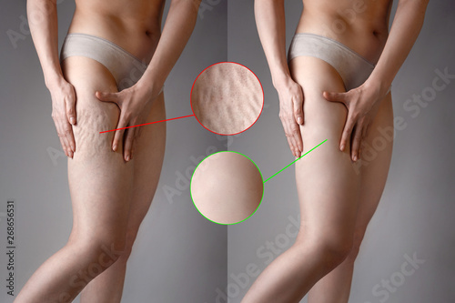 The woman shows cellulite and smooth and delicate skin on her legs. The concept of aesthetic medicine and skin imperfections. Images with magnification of cellulite and delicate skin. Before and after