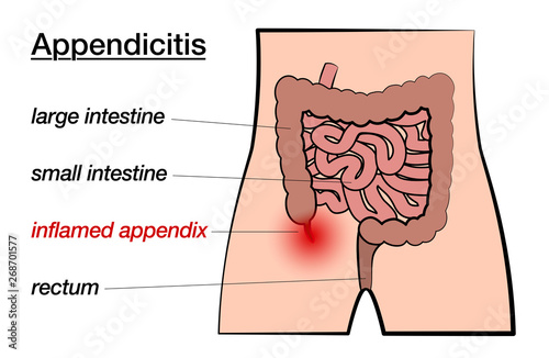 Appendicitis. Inflamed appendix. Labeled chart with large and small intestine, appendix and rectum. Isolated vector on white background.