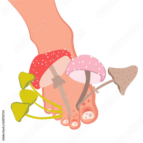 Fungal disease of the skin of the feet and nails. Athlete's foot, onychomycosis, candidiasis. Vector illustration of medical posters and stands
