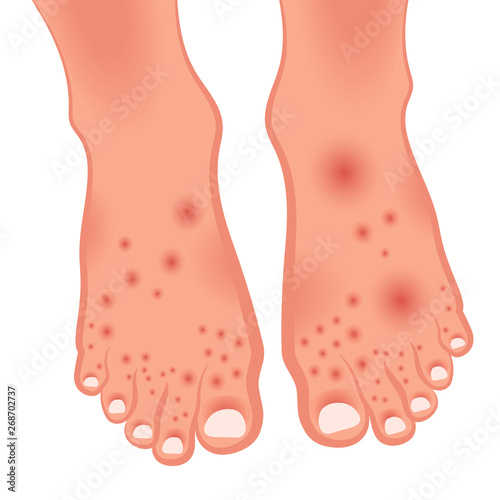 Human leg with skin damage. Dermatitis, neurodermatitis, mycosis, psoriasis. Vector illustration of fungal skin diseases