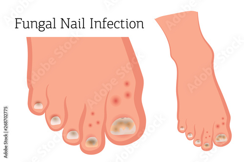 Fungal diseases of the nails and skin of the feet. Athlete's foot, onychomycosis, candidiasis. Vector illustration of medical posters and stands