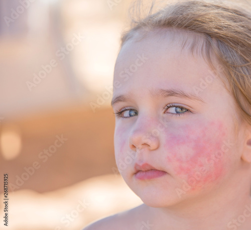 Diathesis in a little girl