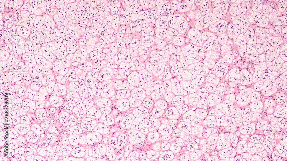 Microscopic image of an adrenal cortical adenoma, a benign tumor of the