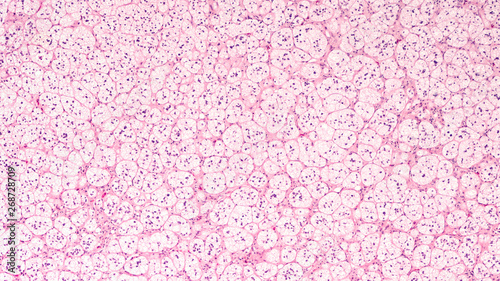 Microscopic image of an adrenal cortical adenoma, a benign tumor of the adrenal gland, which may produce hormones cortisol or aldosterone and lead to Cushing's syndrome or primary hyperaldosteronism. photo