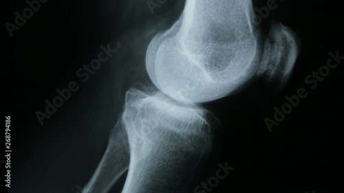 Zoom-in on the x-ray plate of the femur and bones of the human knee, in lateral view.