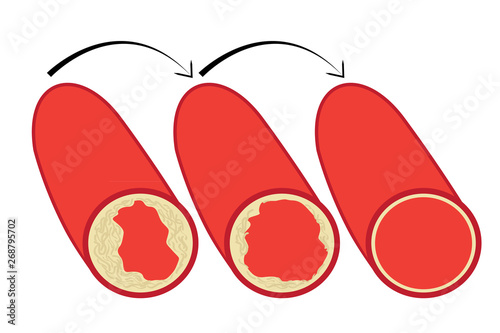 reduce levels of cholesterol plaque in vessels