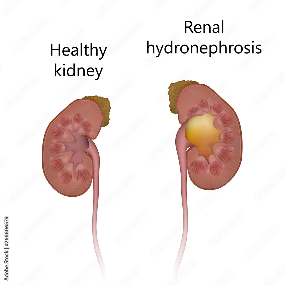 Healthy kidney comparison with hydronephrosis. Distended renal pelvic