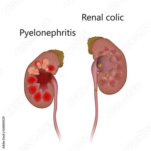 Pyelonephritis comparison with renal colic. Kidney infection, infected, stones. Realistic anatomy vector illustration.