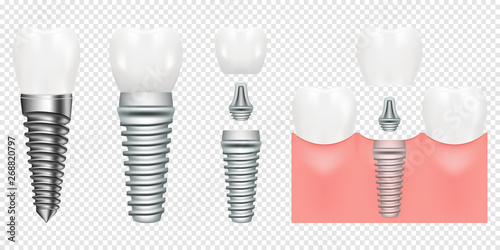 Human teeth and dental implant cut scheme, vector illustration. Dental implant structure with all parts crown, abutment, screw. medical pictorial. Vector illustration