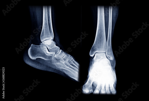 X-ray ankle or Radiographic image or x-ray image of right ankle joint AP and Lateral view for diagnosis of frature ankle.