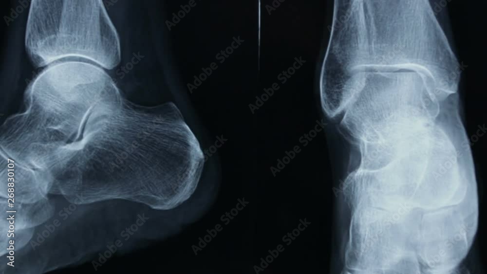 Tibia Zoom Zoom-in of the radiographic plate of tibia and fibula and of bones of ...