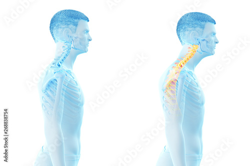 3d rendered medically accurate illustration of a man with a forward head posture