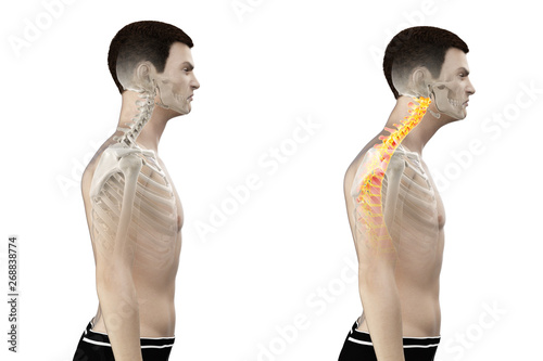 3d rendered medically accurate illustration of a man with a forward head posture photo