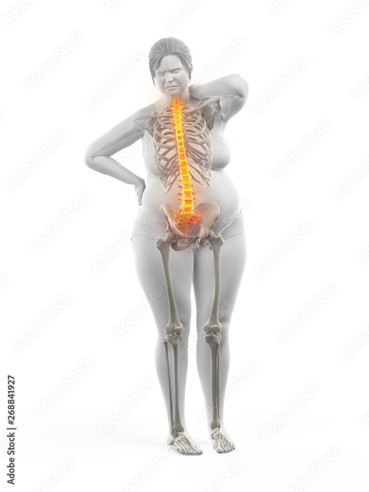 3d rendered medically accurate illustration of an overweight womans painful back