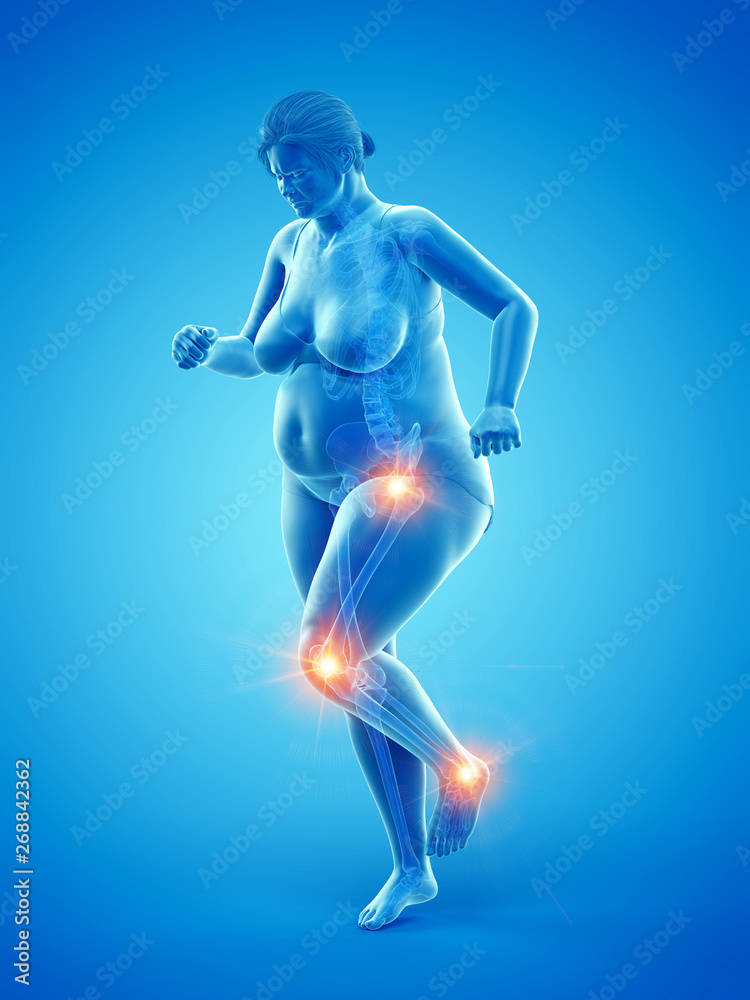 3d rendered medically accurate illustration of an overweight womans painful joints
