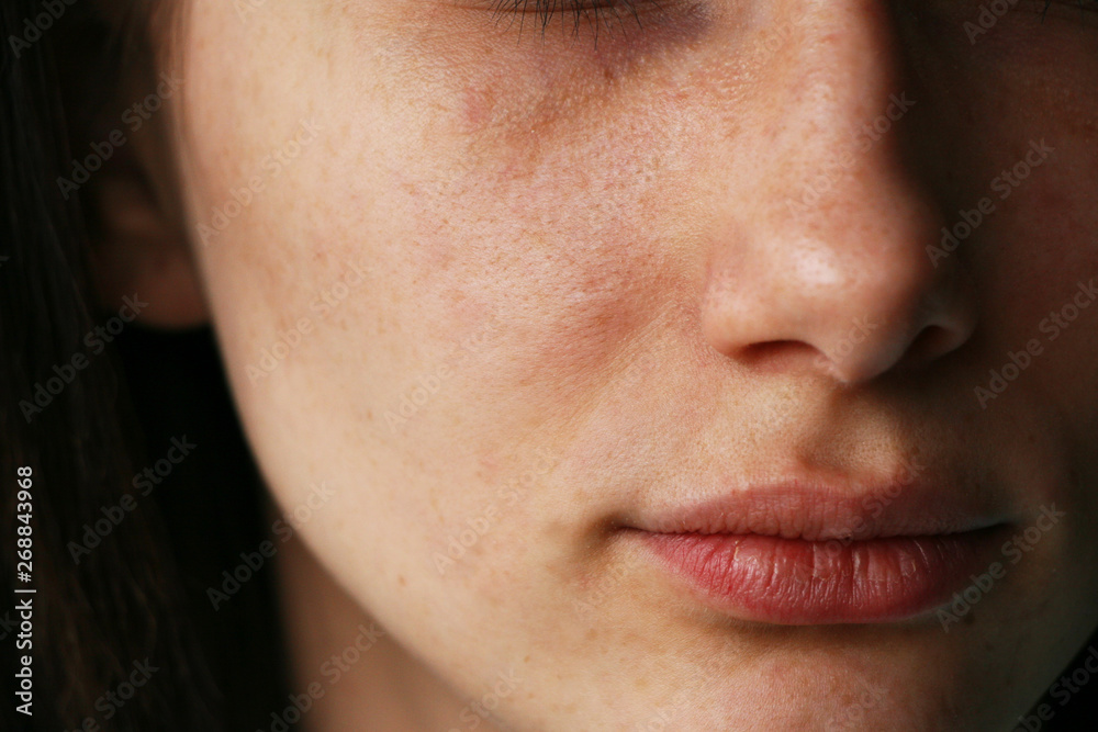 Fototapeta premium skin close-up with black dots