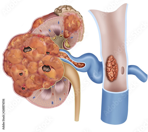 Ilustración anatómica y descriptiva de un tumor cancerígeno avanzado en un riñón con expansión a la vena cava. photo