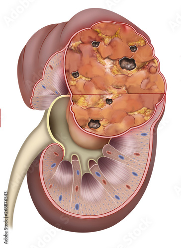 Ilustración anatómica y descriptiva de un tumor cancerígeno de un riñón en estado avanzado. photo