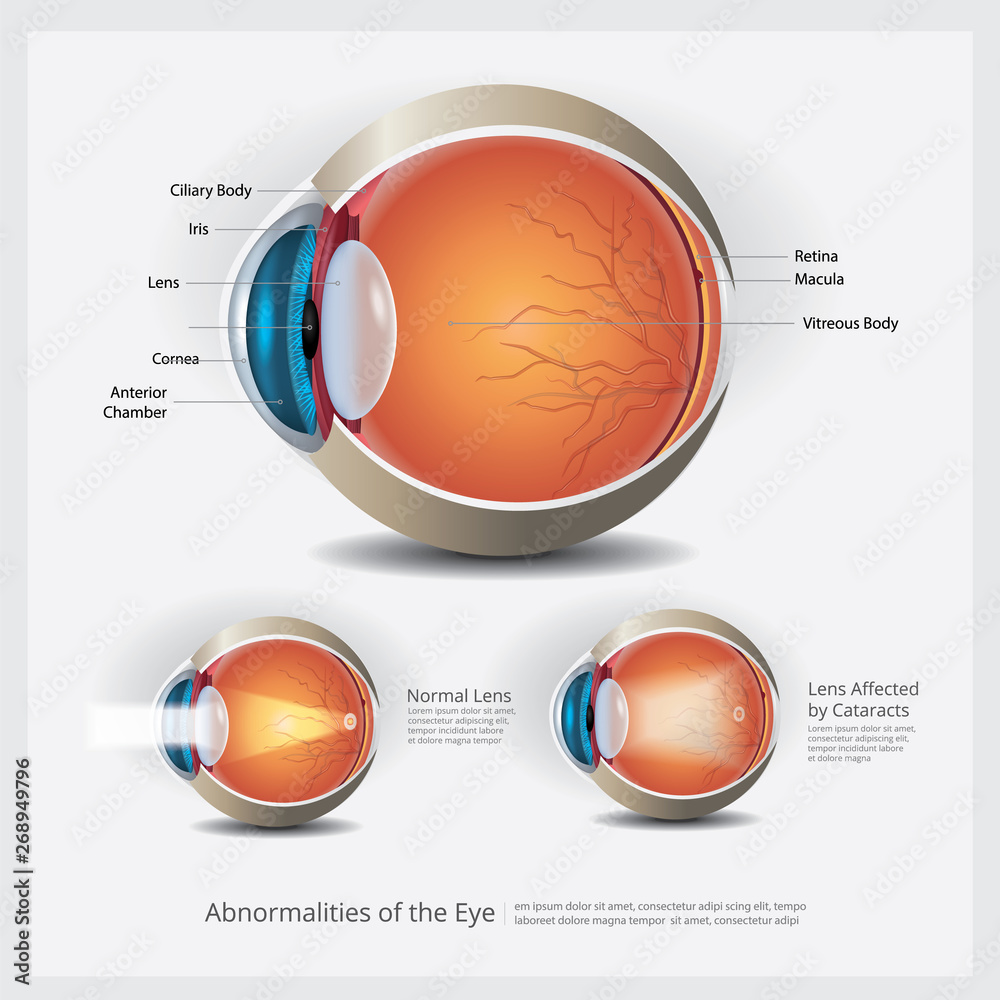 Eye Anatomy with Eye Abnormalities Vector Illustration